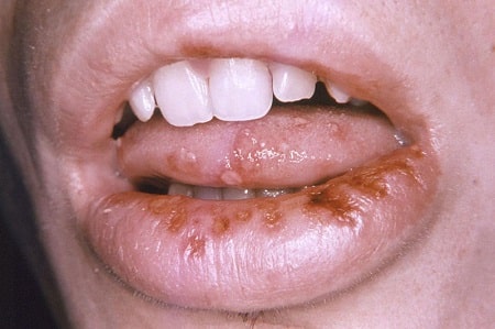 Đâu là các triệu chứng lâm sàng của bệnh giang mai ở miệng?