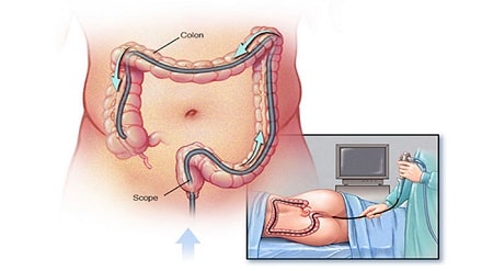 Liệu khám trĩ có cần nội soi không?