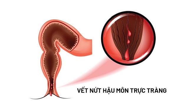 Giải đáp chung về bệnh nứt kẽ hậu môn 