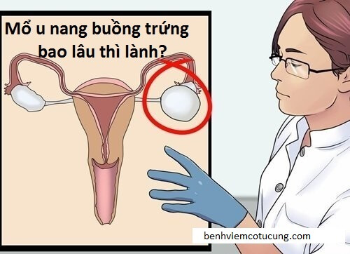Mổ nội soi u nang buồng trứng bao lâu thì lành?
