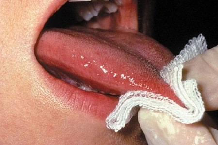 Các yếu tố khiến mụn rộp sinh dục ở lưỡi nhanh bùng phát 