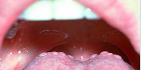 Mụn rộp sinh dục ở lưỡi có tác hại ra sao ?