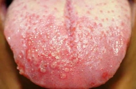 Nguyên nhân dẫn đến mụn rộp sinh dục ở lưỡi là gì ?