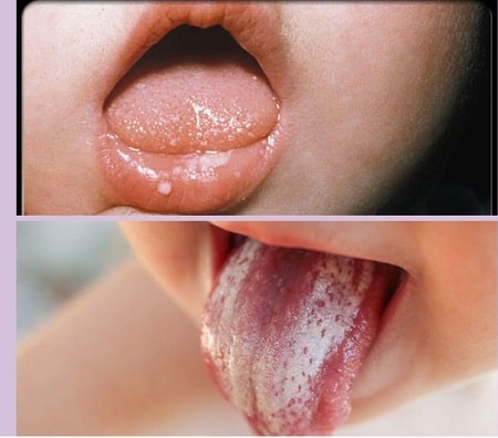 Những triệu chứng gặp phải khi bị nấm candida miệng