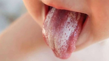 Nấm candida miệng là bệnh gì ?