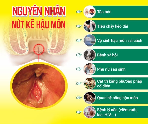 Nguyên nhân gây nứt kẽ hậu môn là do đâu ra có?