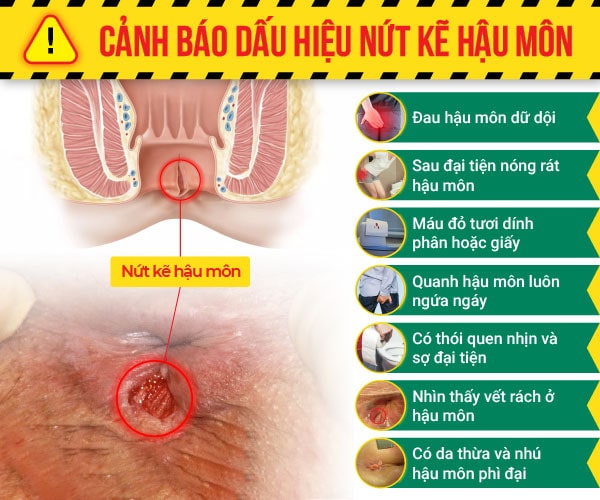 Liệu bị nứt kẽ hậu môn có gây ung thư hay không?