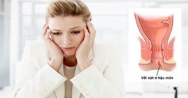 Nứt kẽ hậu môn sau sinh: Do đâu mà có?