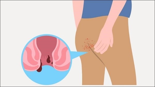 Cẩn thận biến chứng nếu không chữa nứt kẽ hậu môn sau sinh