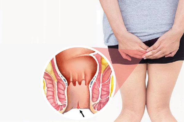 Nứt kẽ sau sinh khác gì với người bình thường bị nứt kẽ hậu môn?