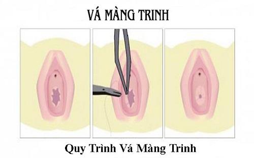 Cập nhật quy trình vá màng trình không phải ai cũng biết