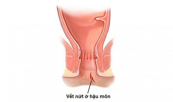 Nứt kẽ hậu môn là gì? Vì sao cần điều trị sớm?