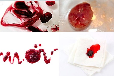 Hiện tượng ra máu ít sau khi phá thai xảy ra do nguyên nhân nào?
