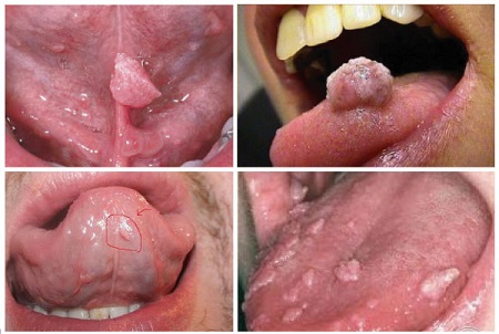 Triệu chứng sùi mào gà ở lưỡi điển hình, cần chú ý