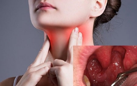 Sùi mào gà ở họng có nguy hại gì cho sức khỏe người bệnh? 