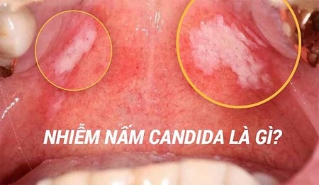 Thông tin chung về tình trạng nhiễm nấm Candida
