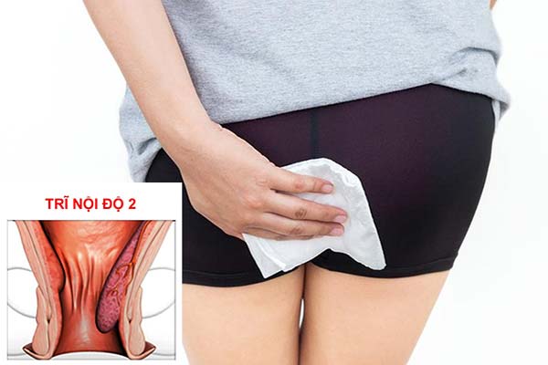 Nguyên tắc khi sử dụng thuốc chữa trĩ nội độ 2