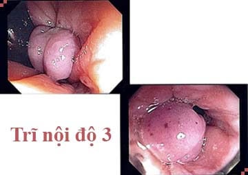 Trĩ nội độ 3 là gì ?