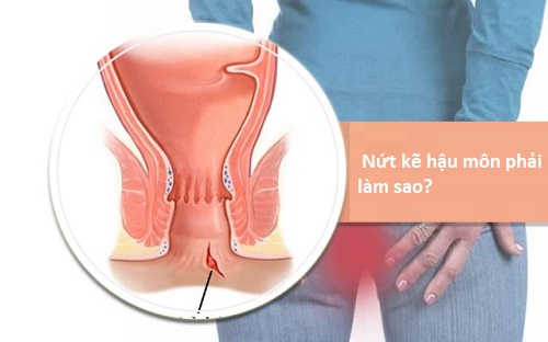 Vì sao thuốc trị nứt kẽ hậu môn thường xuyên được ưu tiên lựa chọn?
