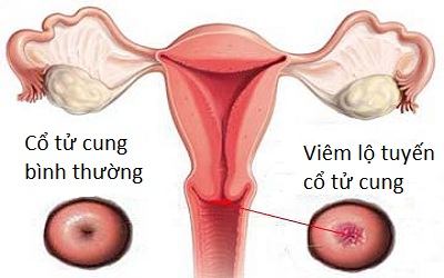 Bệnh cổ tử cung - Viêm lộ tuyến cổ tử cung