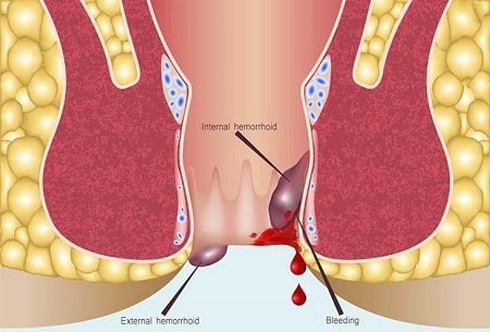 Trĩ nội chảy máu xuất hiện như thế nào?