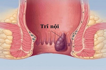 Thông tin tổng quan về bệnh trĩ nội