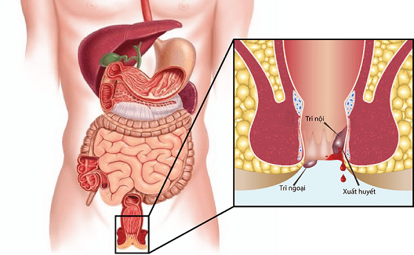 Nguyên nhân gây bệnh trĩ nội cần được chú ý