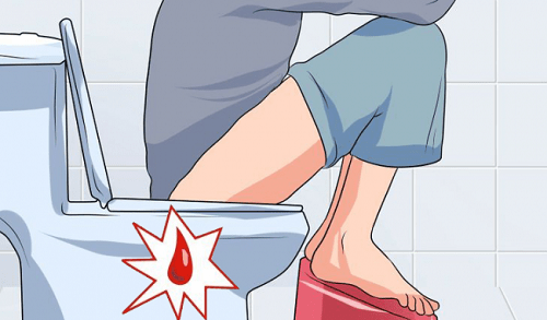 Nguyên nhân gây ra bệnh trĩ nội độ 1 là gì ?