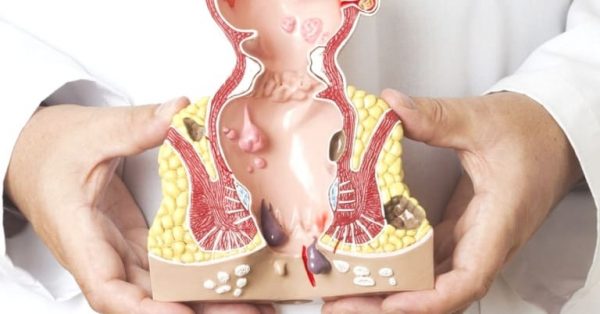 Trĩ nội độ 1 là bệnh lý như thế nào ?