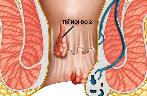 Trĩ nội độ 2 có cần phẫu thuật không?