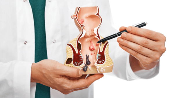 Các thông tin quan trọng liên quan tới trĩ nội độ 2 mà bạn cần biết