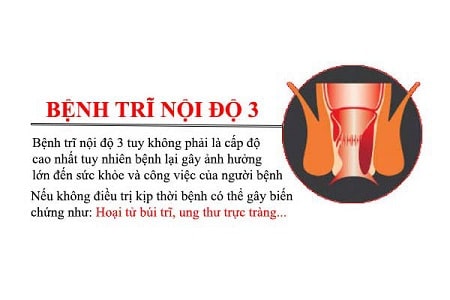 Bệnh trĩ nội độ 3 là gì ?