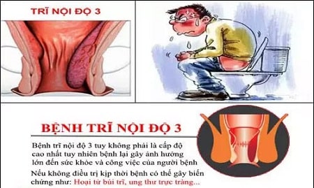 Bệnh trĩ nội độ 3 là gì ? 