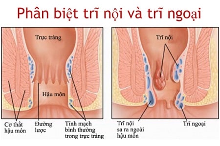 Tìm hiểu: Phân loại trĩ nội và trĩ ngoại