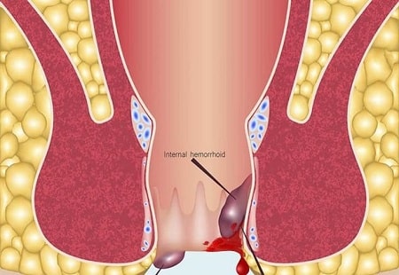 Trĩ nội xuất huyết là gì ?