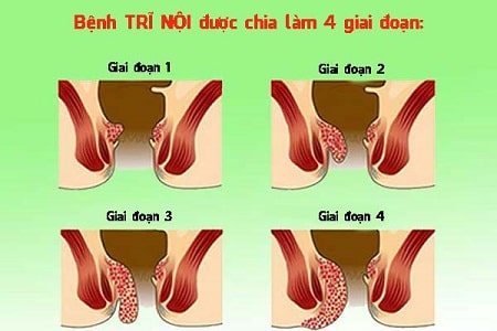 Tổng hợp các triệu chứng trĩ nội theo từng cấp độ 