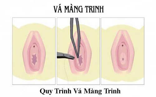 Bạn đã nắm được quy trình thực hiện vá màng trinh chưa?
