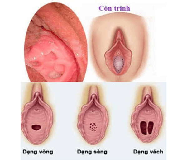 Vá màng trinh là gì ?