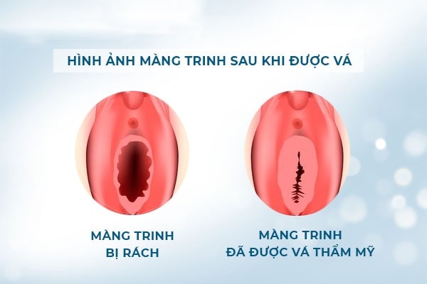 Giải đáp: Thực hiện vá màng trinh đau không ?