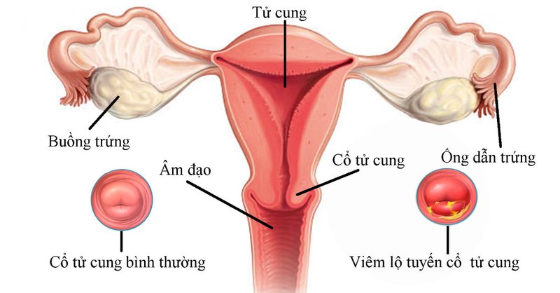 Viêm lộ tuyến cổ tử cung là bệnh gì ?