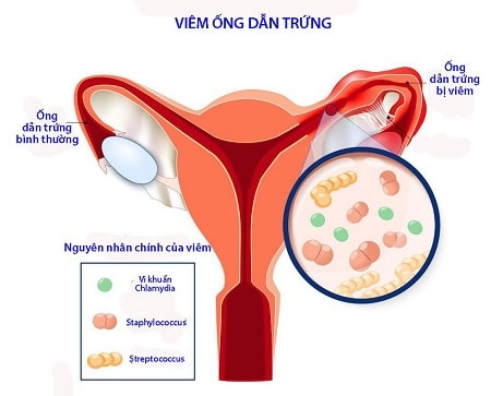 Nguyên nhân bị viêm ống dẫn trứng ở nữ giới ?