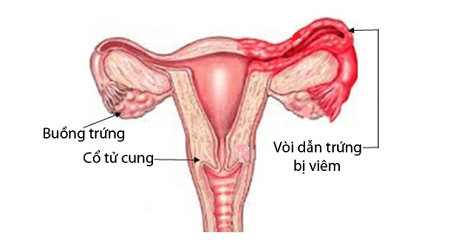 Tìm hiểu về bệnh viêm ống dẫn trứng nữ giới